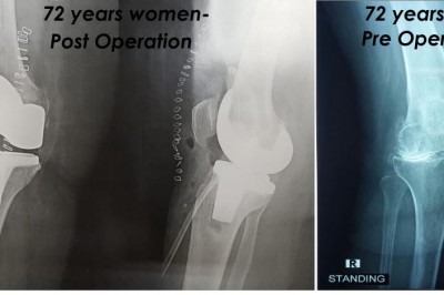 Age Is Just a Number: Elderly Man and Woman Combat Osteoarthritis through a Surgical Procedure