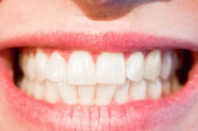 Tooth Bonding In Abu Dhabi | Emirates Royal Center